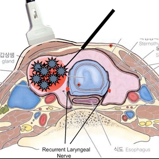 Thermal ablation with radio frequency