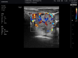 L’impatto della ecografia nella diagnosi dei noduli tiroidei