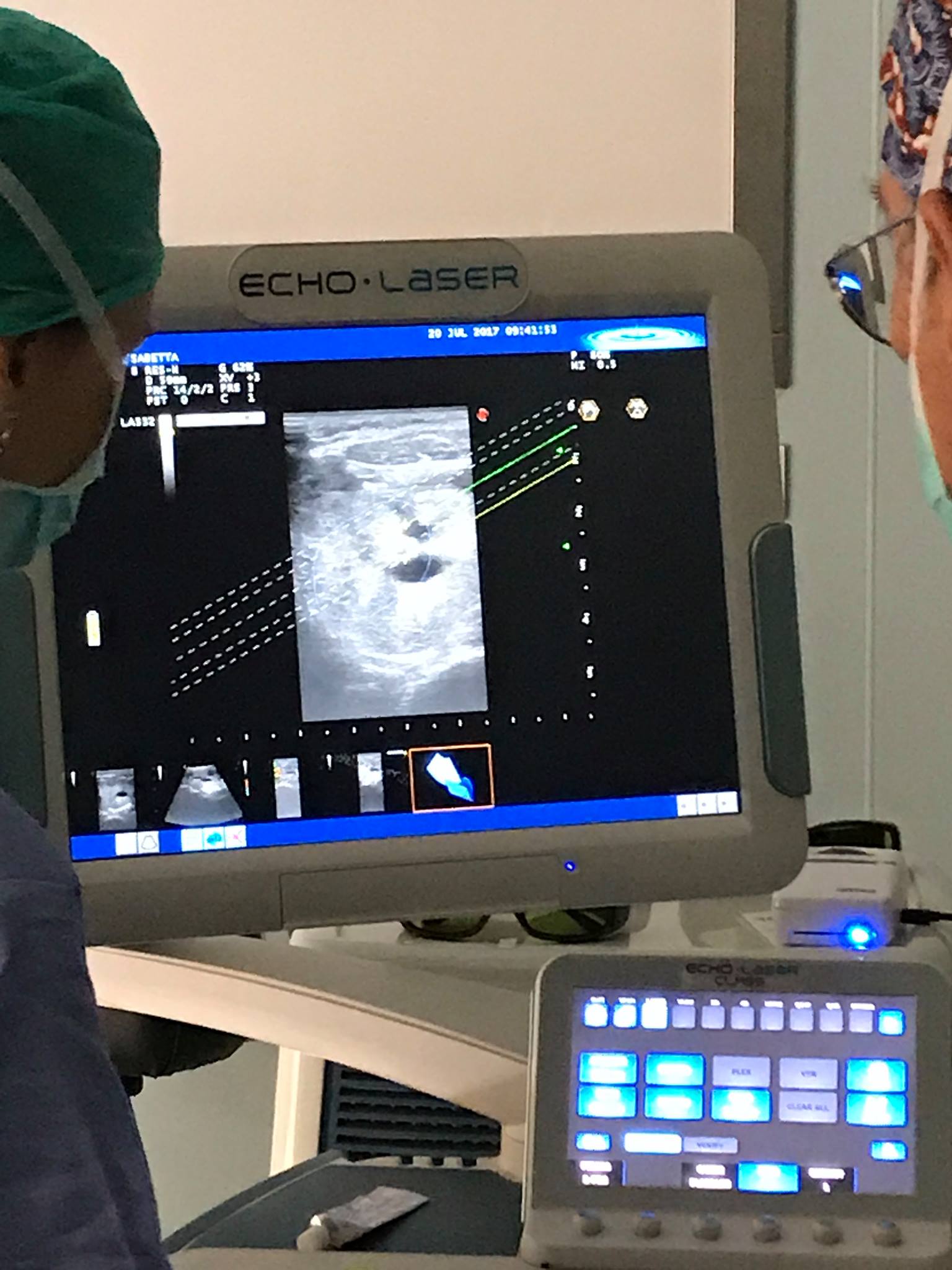 Termoablazione laser di noduli tiroidei all'Ospedale del mare
